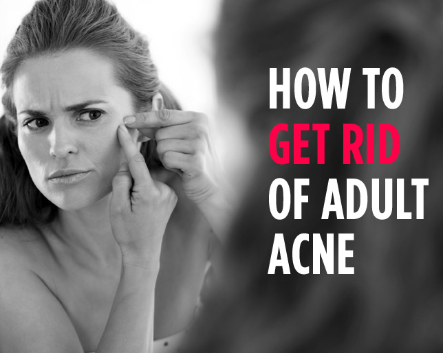 wh get rid of adult acne 0