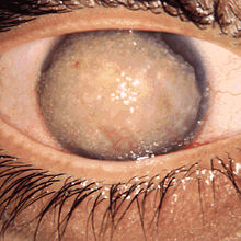220px Gelatinous drop like corneal dystrophy 1