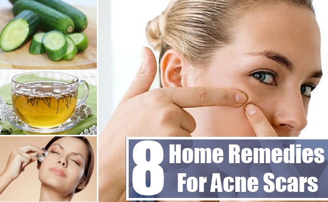 Home Remedies For Acne Scars1