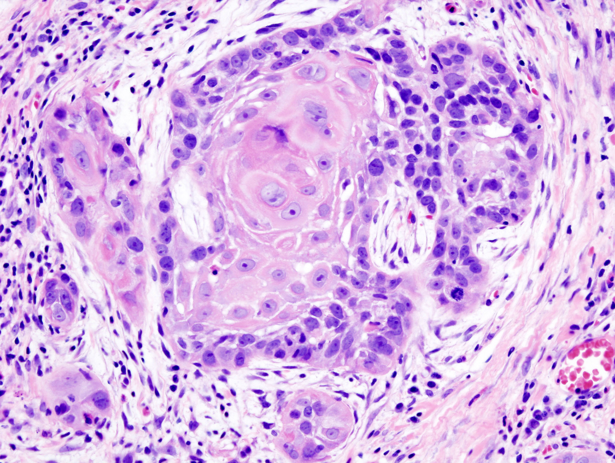 Oral cancer 1 squamous cell carcinoma histopathology