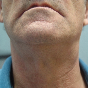 Soft Palate Squamous Cell Carcinoma W Neck Metastasis SQ 300