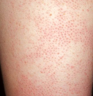 red bumps on my arms keratosis pilaris acne treatment ny