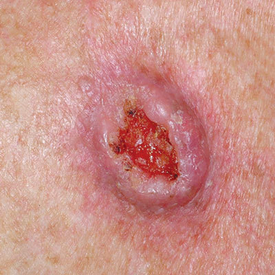 skin cancer carcinoma