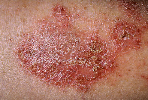 dermnet rf photo of nummlar eczema