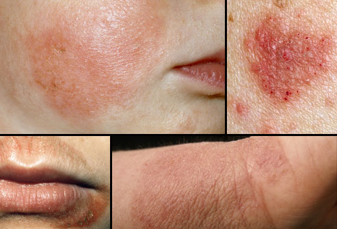 webmd rm photo of eczema types