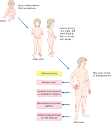 220px Pattern of atopic eczema varies with age