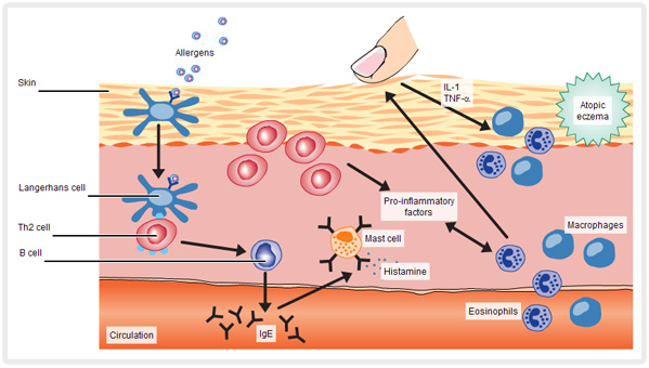 immune response dysfunction in atopic dermatitis sml