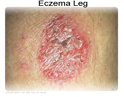eczema leg