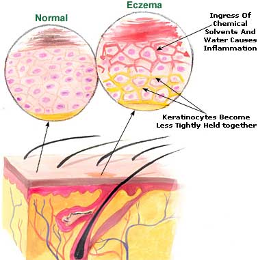 eczema picture